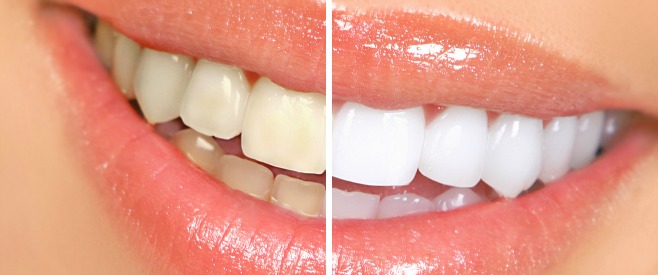 黄色い歯で悩んだら！自宅でできる歯を白くする方法３つのイメージ画像